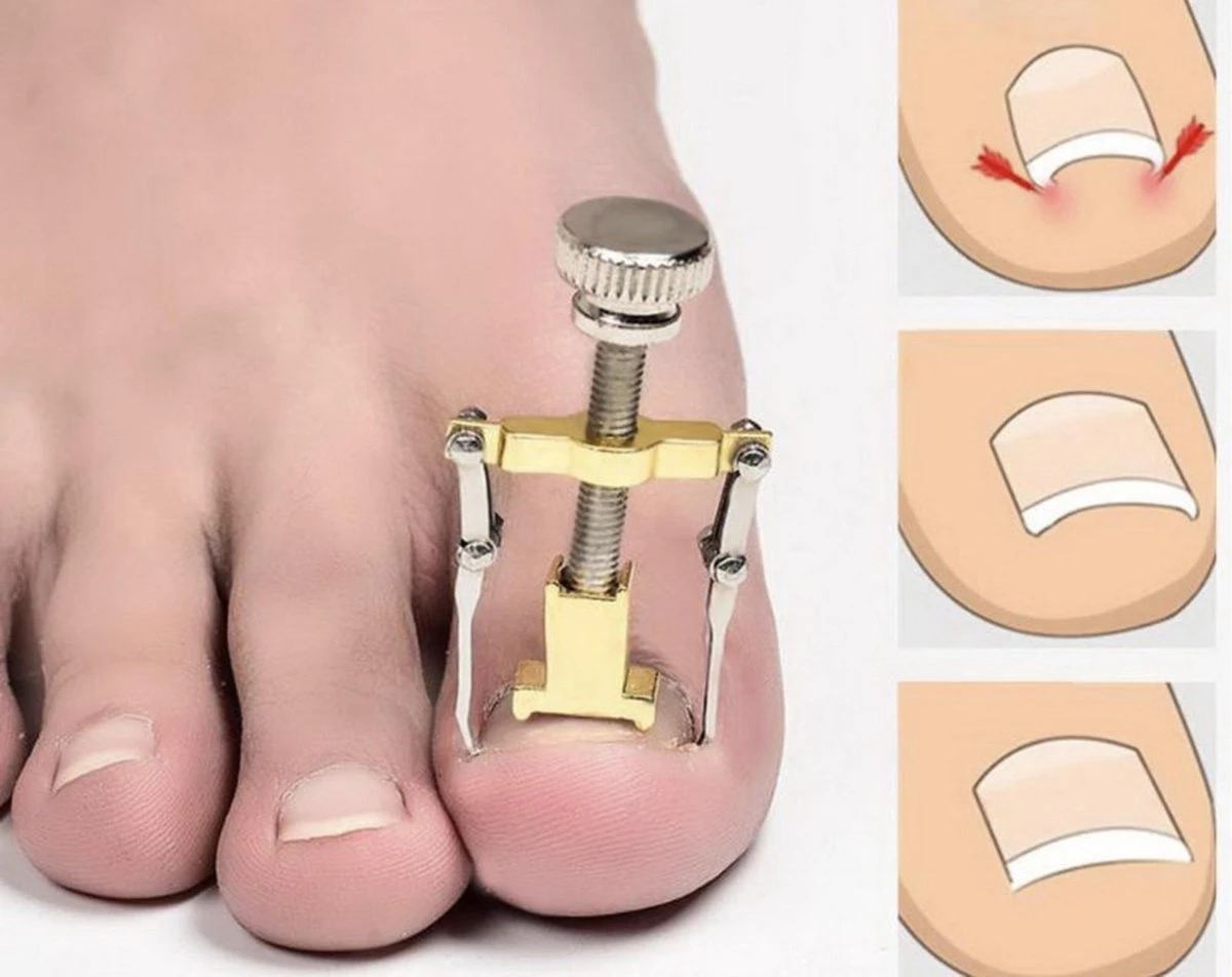 Merkloos Ingegroeide Teennagel Lifter / Corrector | Ingegroeide Vingernagel Vingernagels Teennagels Correctie | Nagel Corrector / Lift 1 Merkloos Ingegroeide Teennagel Lifter / Corrector | Ingegroeide Vingernagel Vingernagels Teennagels Correctie | Nagel Corrector / Lift